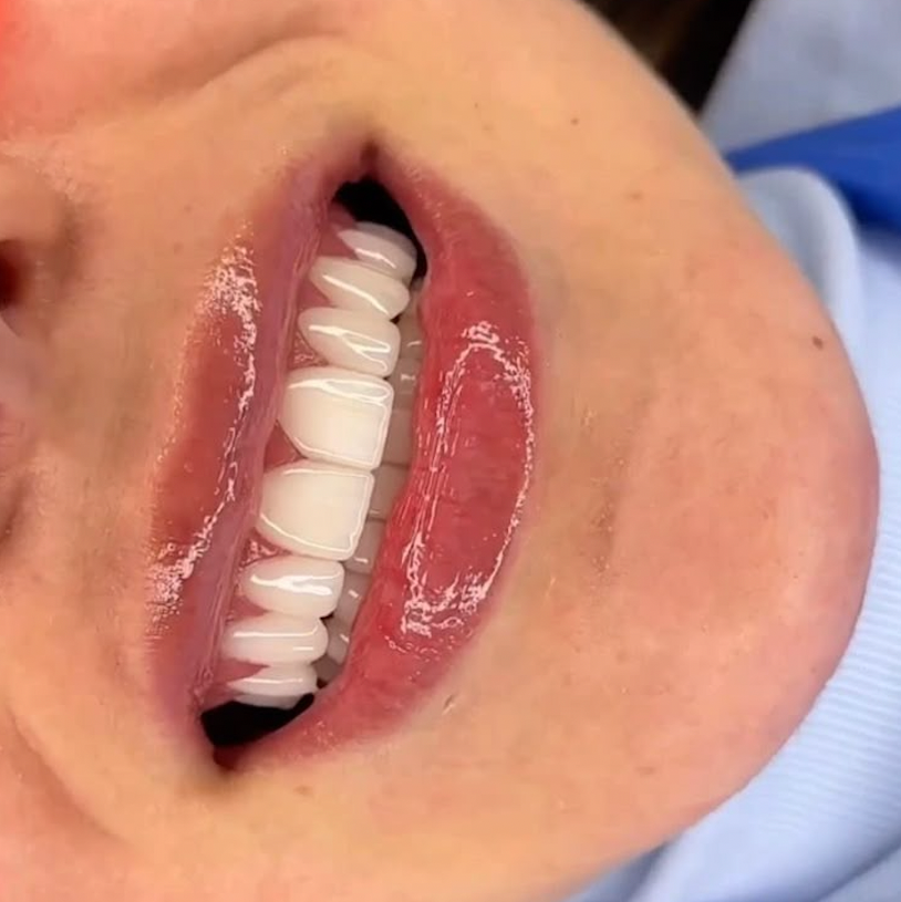 Professional Teeth Whitening Course