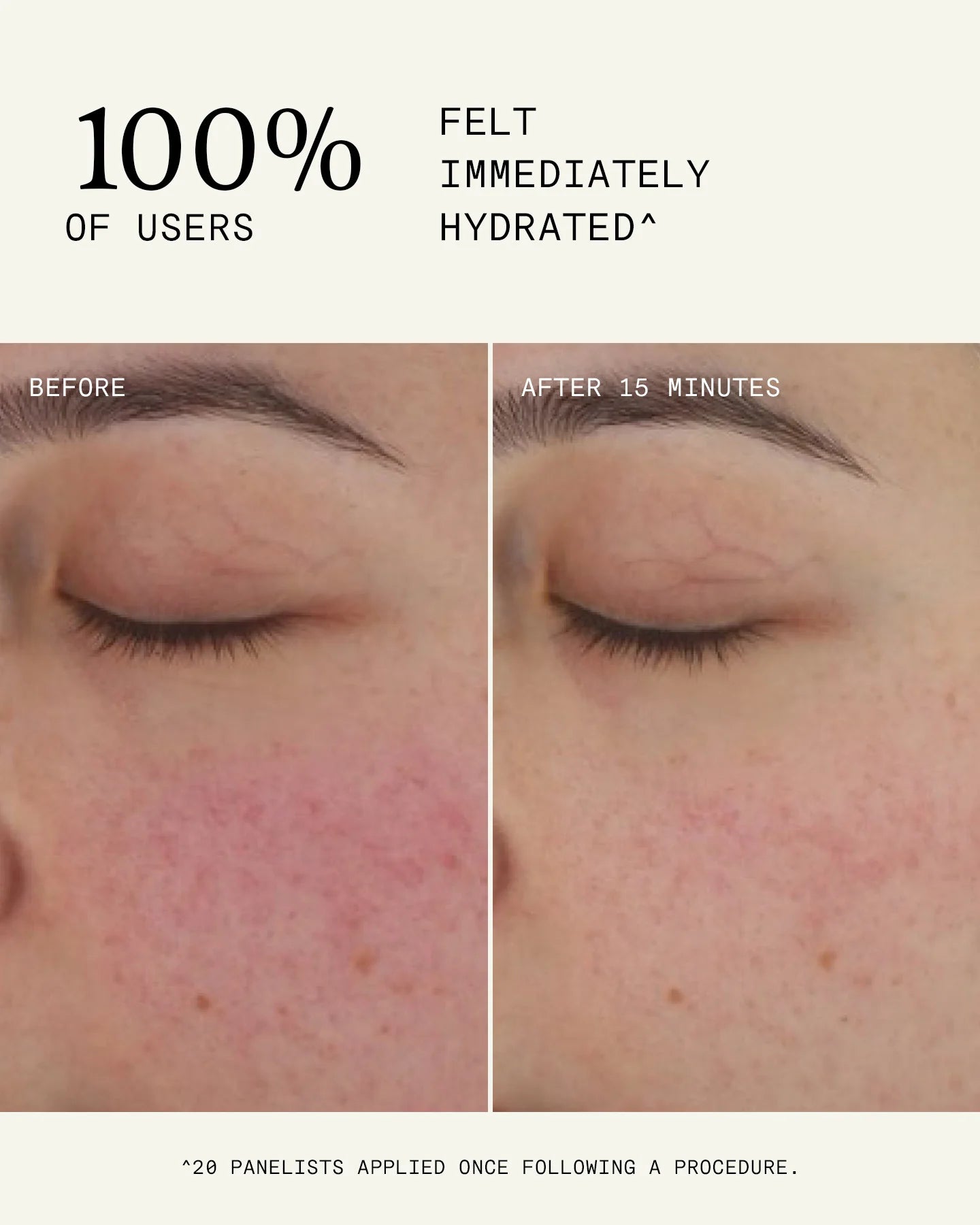 Recovery Cream | Post-Treatment & After Sun Moisturiser