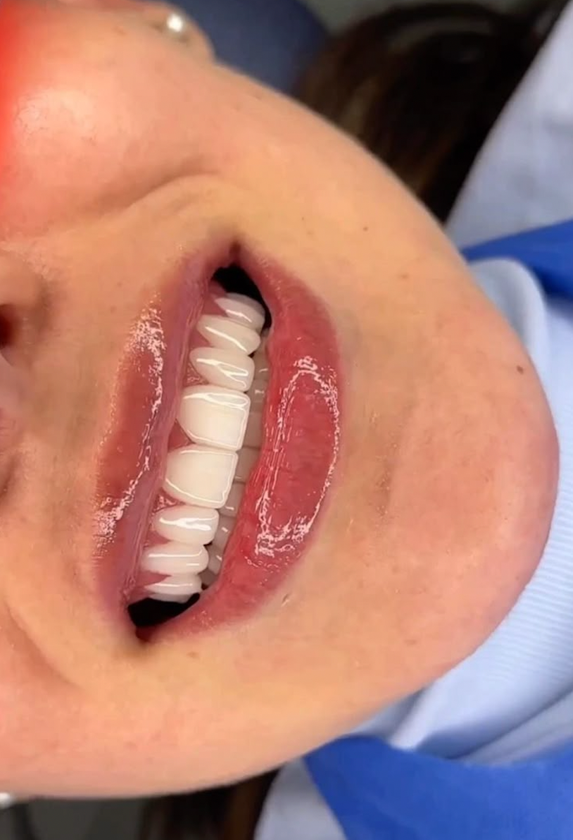 Teeth Whitening Course